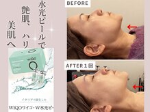 プレジィール 小顔 痩身専門店(PlaisiR)/ハーブピーリング超え水光ピール