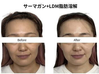 シャムリー(SHAMRY)/サーマガン500ショット+LDM