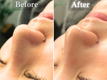 ボーンオム(Born Homme)/毛穴洗浄＋美容液導入：30代男性