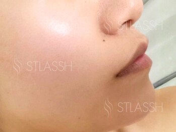 ストラッシュ 名古屋駅前店(STLASSH)の写真/脱毛×エレポレで毛穴ケア＆化粧ノリUPを目指す♪ストラッシュ名古屋駅前店でオススメの顔脱毛！