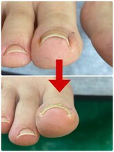 名古屋駅前巻き爪センター/陥入爪