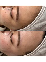 ホワイトワックス 京都四条烏丸(WHITE WAX)/生え際もスッキリ◎