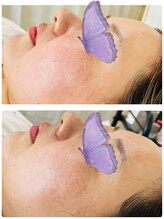 クリア アイラッシーズ アンド ネイルサロン シャイン(CLEAR & SHINE)/ヴィーナスカレントマスク