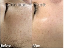 ココスターリー(Coco starry)/シミケア☆1ヶ月1回照射10ヶ月後