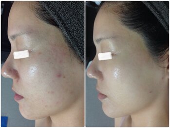 ルノン(LUNON)/ニキビケア　ビフォーアフター