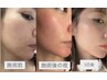 【人気No.1】肌質改善＆毛穴ケア　タルミ、シミ、肌荒れ、これで叶っちゃう♪