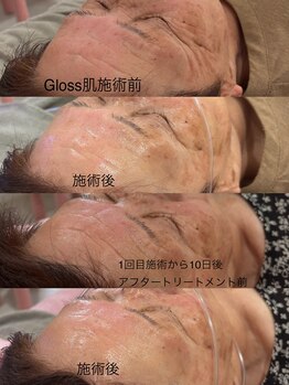 リリーミー(Rily Me)/Gloss肌トリートメント施術後B/A