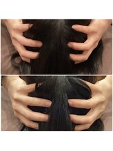 ハリラックス(HA:Ri/LAX)/【小顔矯正のビフォーアフター】