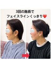 顔凛(カオリン)/40代/女性の小顔矯正