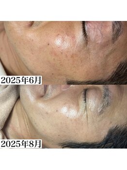 フェミナ(femna)/ポテンツァフェイシャル