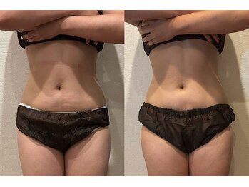 ユー 喜連西店(U)/脂肪冷却【before after】