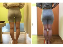 あさひ整骨院 鍼灸院/O脚矯正での変化写真