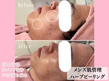 エンクリニカルラボ 三宮店(E&N CLINICAL LABO)/幹細胞ハーブピーリング