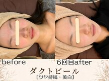 エスポワール(espoir)/before・after