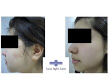 フェイシャルスタイリストサロン 高崎店(Facial Stylist Salon)/ケア例（75）