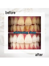 ホワイトニングショップ 亀戸店/【亀戸】美白ホワイトニング