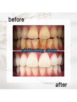 ホワイトニングショップ 亀戸店/【亀戸】美白ホワイトニング