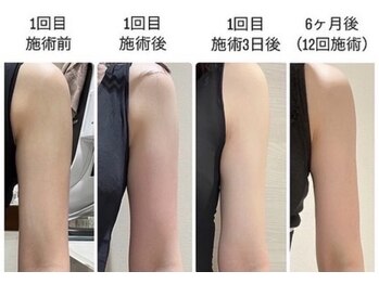 Nビューティー/最新RFサーモシェイプオーパス