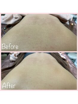 レディソワン(Lady Soin)/お背中ワックスBeforeAfter