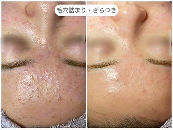 フラックス 京都(FLUX)/【エンビロン】毛穴集中コース