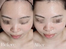 ウィハナ(wehana)/【ハーブピーリング】ニキビケア