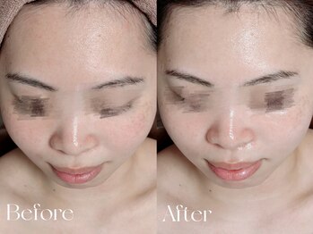 ウィハナ(wehana)/【ハーブピーリング】ニキビケア