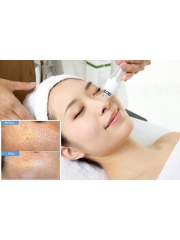 毛穴ケアをしたい