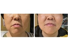 ねこのひげ/お顔の変化