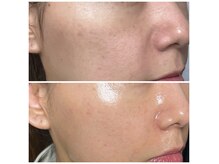 ルーナ(Luna)の雰囲気（【プラズマシャワー×リジュラン】真皮層まで美容成分導入。）