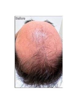 カブール 町田/薬に頼らない育毛促進