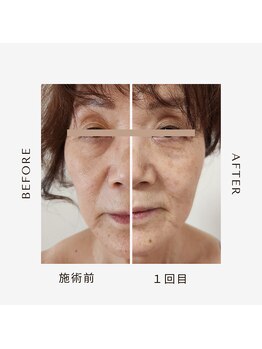 ロータスマップ(LOTUS MAP)/フェイシャル/小顔たるみケア