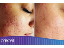 ママナ(mamana)/ヒト骨髄幹細胞フェイシャル導入