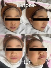 レアレアケー(Lea Lea_K)/ワックス脱毛