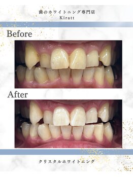 キラット 栃木店(Kiratt)/クリスタルセルフホワイトニング