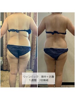 ヴィオテラス(VIOTERACE)/WINBACKウィンバック症例3