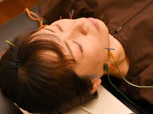 大砂土治療院/電気の美容鍼でリフトアップ効果