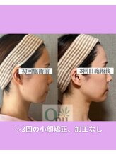 キュープ 富士店(Qpu)/まるで別人！富士市小顔/エラ