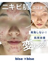 ビズビズ 梅田店(bisebise)/5～10年長年のニキビ悩みの方へ