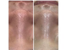 ジョアアンジェ 京橋店(joie ange)/日焼けによる黒ずみ毛穴にも！