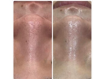 ジョアアンジェ 京橋店(joie ange)/日焼けによる黒ずみ毛穴にも！