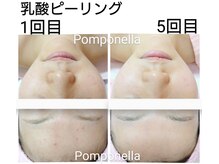 ニキビ滅亡＆つるスベ肌に♪ファンデのりも良く透明感UP！