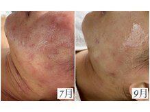 レイ(Rey)/オーダーメイド肌質改善