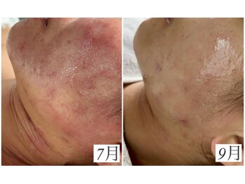 レイ(Rey)/オーダーメイド肌質改善