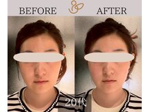 チョコバリ 新宿店(chocobari)/小顔×リフトアップ(美容鍼)20代