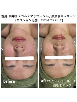 クラリ(Clari)/小顔/浮腫み/たるみ