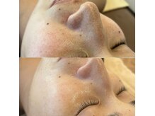 月に一度お肌に栄養をいれていくバクテリウムピール！