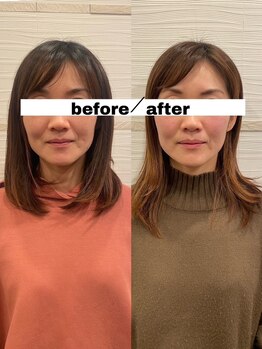 長寿鍼灸院 長寿整骨院/美容鍼50本の効果★(3回目）