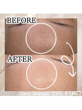 ケア ラウンジ ザ ファースト(THE F1RST)/肌質改善＊ビフォーアフター