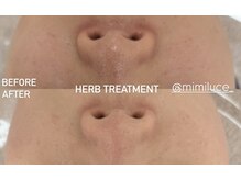 ミミルーチェ(mimiluce)/1回で毛穴きゅっと引き締め◎