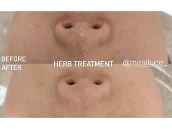 ミミルーチェ(mimiluce)/1回で毛穴きゅっと引き締め◎